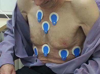 18 3.2.2 Toimenpidekuvaus Ennen EKG-pitkäaikaisrekisteröinnin aloittamista lääkäri selittää potilaalle tutkimuksen yksityiskohdat ja vastaa potilaan esittämiin kysymyksiin.