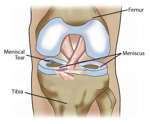 24 KUVA 12. Polven sisemmän meniskin repeämä (Meniscal tear 2014) Patellan sijoiltaanmenolle johtaa tyypillisesti fleksiossa olevaan polveen kohdistuva vääntyminen sisäänpäin valgukseen.