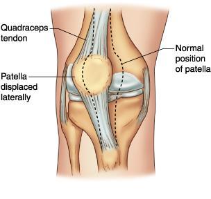 Kun polvinivel ekstensoituu, luksoitunut patella luiskahtaa itsestään takaisin oikealle paikalleen. Anatomisena altistava tekijänä tunnetaan mm. pihtipolvisuus.