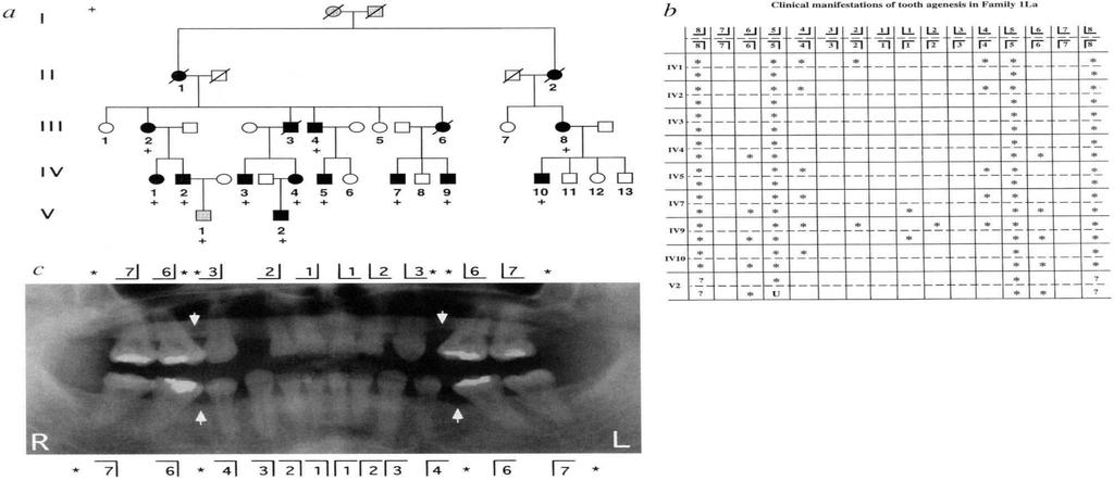 Genetic linkage analyses in a family with autosomal dominant agenesis of second premolars and third molars identified a locus on chromosome 4p, where the MSX1 gene resides.