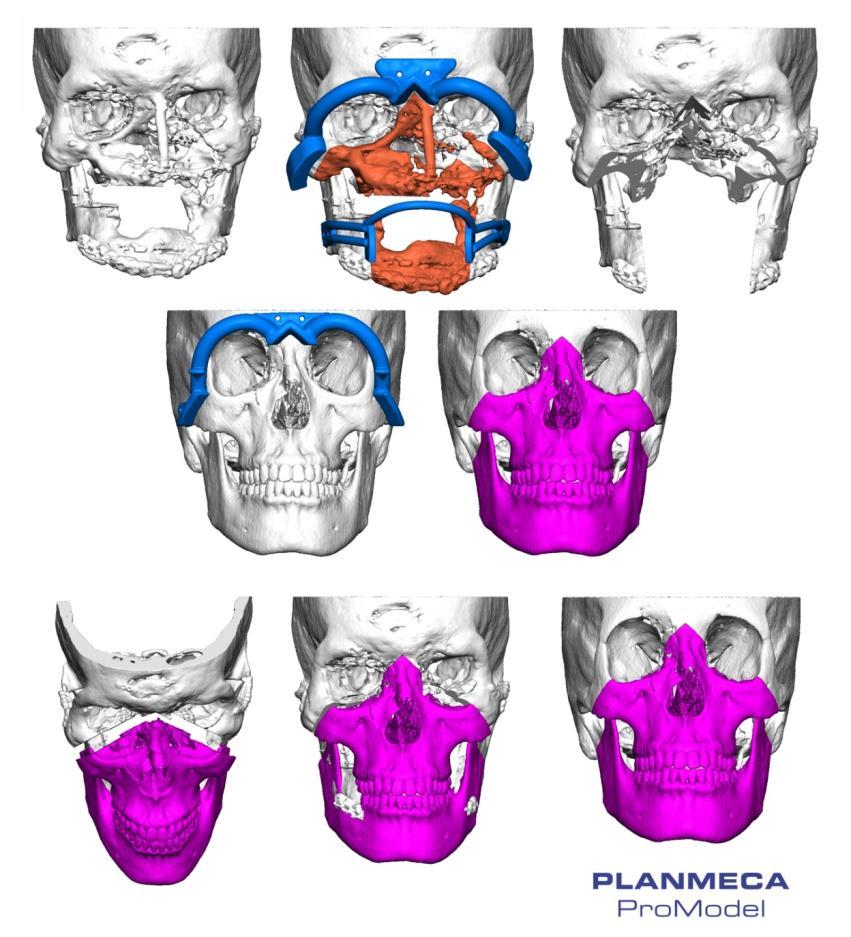 HUS and Planmeca cooperation Cooperation spans nearly a decade Facial reconstruction very demanding due to the complexity of facial bones Advantages of 3D planning from surgeon s
