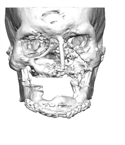 Advantages of 3D planning Preoperative planning of the operation Simulating