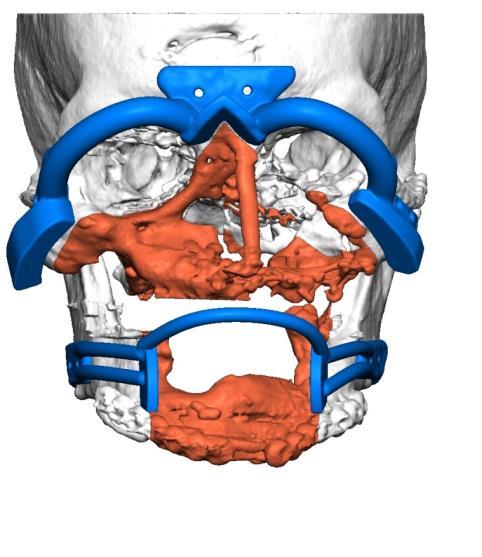 printed anatomical models With the help of 3D designed surgical guides an