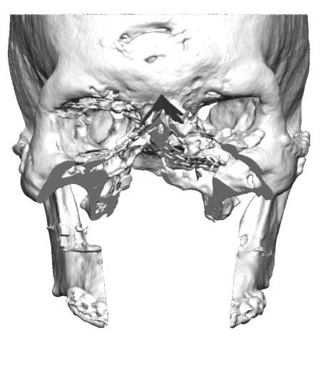 Patient specific surgical guides With the help of the surgical guides the