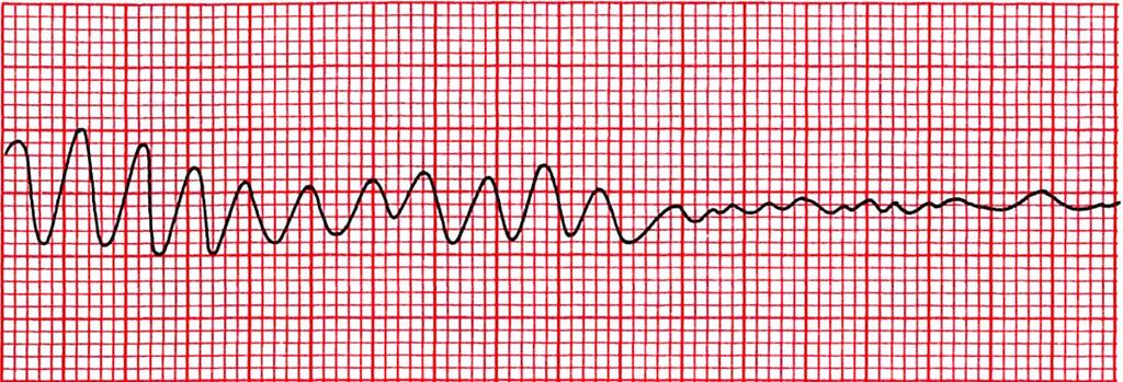 20 Kammiovärinä (VF) on rytmihäiriö, jossa sähköinen toiminta sydämessä on täysin kaoottista (Kuisma 2013, 259).