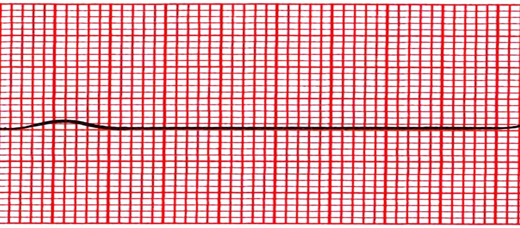 21 KUVA 8. Asystole EKG:ssa (Thaler 2007, 109 muokattu) Sykkeettömässä rytmissä (PEA) sydämessä on sähköistä toimintaa, mutta sydämen pumppaustoiminta on loppunut.