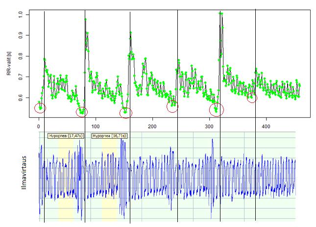 20 4.4. Valsalva-ilmiö sykevälivaihtelussa Tutkittaessa tarkemmin hengityskäyrää ja sykevälivaihtelukäyrää, huomataan että sykevälivaihtelun muutokset tapahtuvat samanaikaisesti hengitysmuutosten