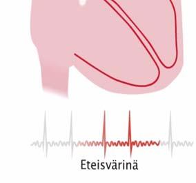 t viikossa lisää eteisvärinäriskiä yleispopulaatiossa (Mont et al EHJ 2002) Eteislepatuksen