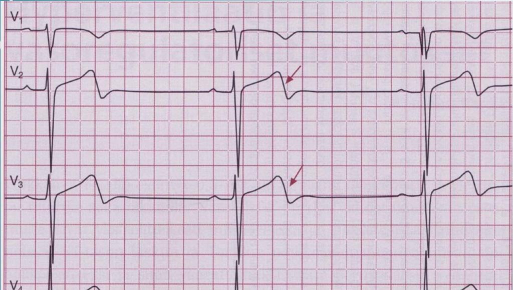 URHEILIJAN EKG Bradykardia Hidas syke 1. ja 2.