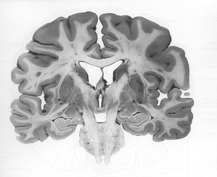 EPILEPTIKUS 1 % KOURISTELU 13% AIVOVEREN- VUOTO 4 % SAV 2 % POLYRADIKU-