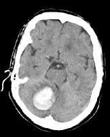 VERENVUOTOMUUTOSTEN ILMAANTUVUUS LIUOTUSHOIDOSSA 6-11 % 8 % 6 4 HEMORRAGINEN TRANSFORMAATIO PARENKYYMIHEMATOOMA 2 0 P.