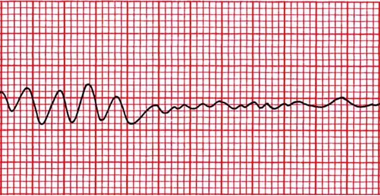 18 KUVA 3. Kammiotakykardia hiipuu kammiovärinäksi (Thaler 2007, 135 muokattu) Asystole (ASY) tarkoittaa sydämen pumppaustoiminnan ja sähköisen aktivaation puutetta.