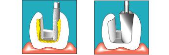 5 Käyttö 5.1 Tehoasetus SONICflex 5 Käyttö 5.1 Tehoasetus SONICflex Asetussuositusten noudattamatta jättämisestä aiheutuva vaara. Asetussuositusten noudattamatta jättäminen johtaa kärjen murtumiseen.