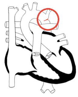 17 4.3.2! Pulmonaalistenoosi (PS) Pulmonaaliläppä on oikean kammion ulosvirtauksen ahtauma ja se voi sijaita joko läppätasossa tai sen ylä- tai alapuolella.