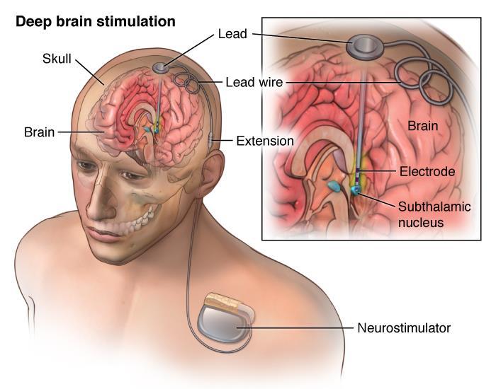 D B S ( S Y V Ä A I V O S T I M U L A A T I O ) Neurokirurgi asentaa elektrodit aivoihin ja sähköisen stimulaattorin ihon alle rintakehälle.