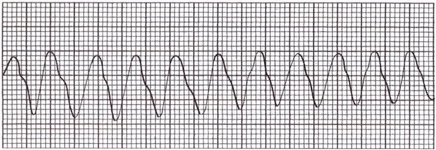 7 Manuaalinen defibrillaattori eroaa puoliautomaattisesta defibrillaattorista siten, että käyttäjän pitää itse tulkita monitorista näkyvää rytmiä ja tehdä päätös defibrilloimisesta ja iskuun