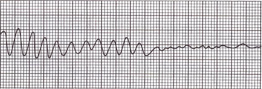 9 KUVIO 2. Kammiovärinä (Kuisma ym. 2013, 144). Kammiovärinän suositeltu hoito on välitön maallikkoelvytyksen aloittaminen ja varhainen defibrillaatio (European Resuscitation Council 2015).