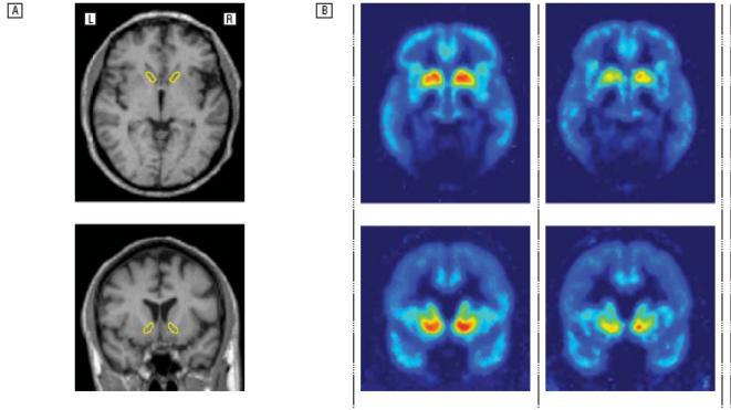 Accumbens-tumake: suurempi -reseptorien määrä alkoholisteilla Alkoholistit Kontrollit