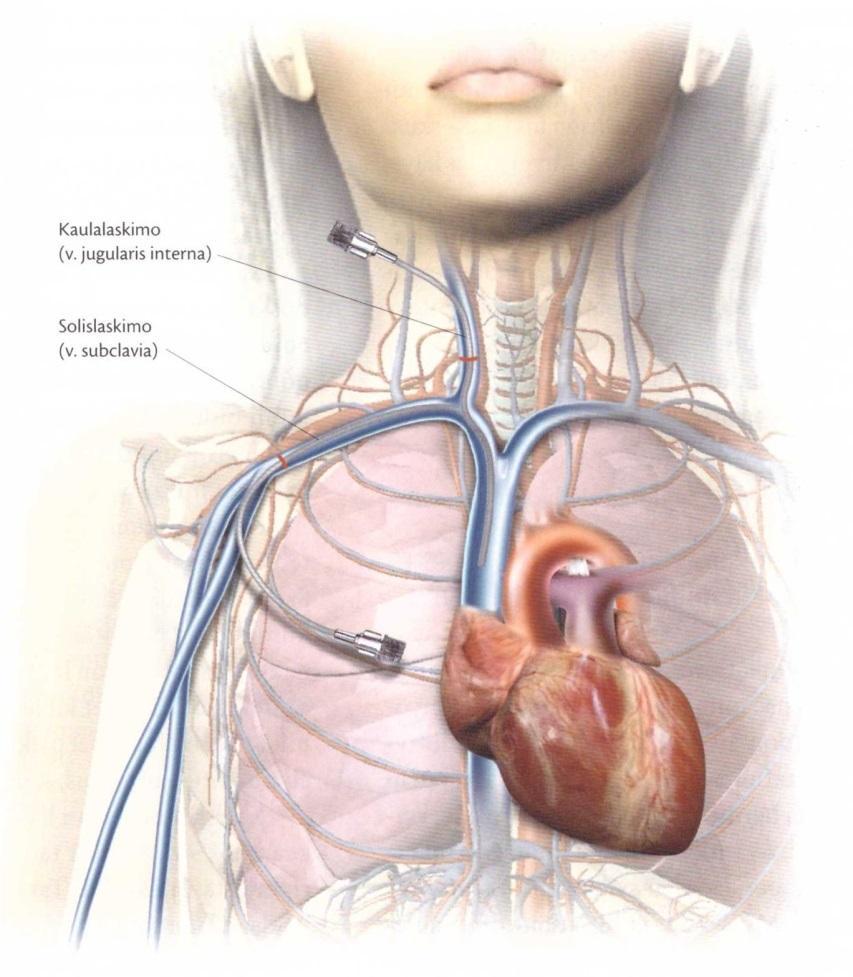 9 Kuva 1. Keskuslaskimokatetrin sijainti. (Saano &Taam-Ukkonen 2013, 265.) 2.1.1 Keskuslaskimokatetrin käyttöaiheet Keskuslaskimokatetria käytetään tilanteissa, joissa ääreislaskimon kanylointi ei jostain syystä onnistu.