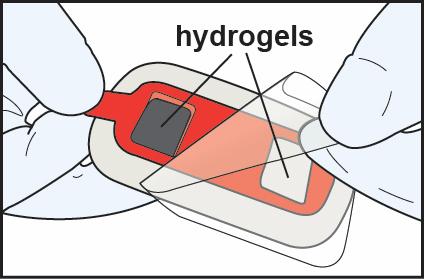 3. IONSYS-valmisteen kiinnitys hydrogeelisäiliöt Poista ja hävitä liimateippiä peittävä kirkas muovikelmu. Varo koskemasta hydrogeelisäiliöitä.