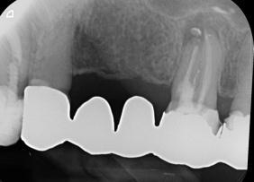 Hampaiden harjaus: pehmeä harja (Sensodyne soft, saatavilla ainakin apteekeista sekä päivittäistavarakaupoista). Hampaiden harjaus aamuin illoin kuivasuiselle tarkoitetulla hammastahnalla(bioxtra).