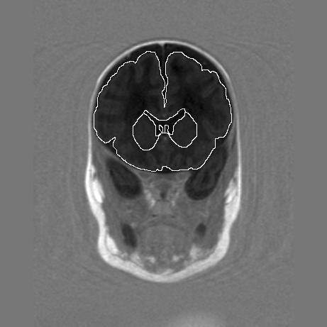 Tupakka ja aivojen rakenne 17 Raskauden aikana tehdyllä MRI:llä todettiin tupakoinnille altistuneilla pienemmät aivotilavuudet loppuraskaudessa (277.5 vs. 246.5 cm3, p = 0.