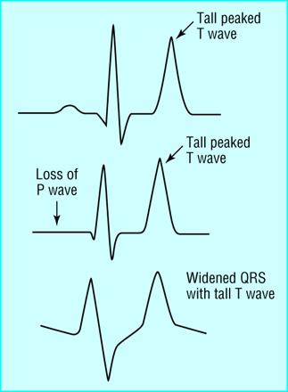 HYPERKALEMIA-EKG EKG 1. Slovis and Jenkins BMJ 2002; 324:1320 S-K (mmol/l) Muutos 5.