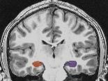 Hippocampal Volume Right / Left Nagel et al.