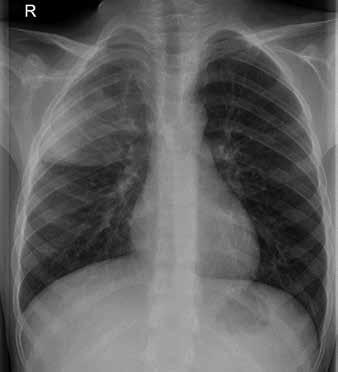 TAULUKKO. Lasten keuhkokuvauksen aiheet. Keuhkokuumeen vaikeuden ja komplikaatioiden arviointi Keuhkokuume vaatii sairaalahoitoa lapsen iän (alle vuoden ikäiset) tai voinnin takia.