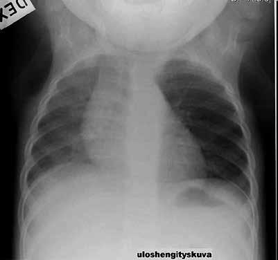 oikealle. Bronkoskopiassa todettiin vierasesine vasemmassa pääkeuhkoputkessa. aiheuttaa astmaan viittaavat oireet tai ainakin pahentaa niitä (TAULUKKO).