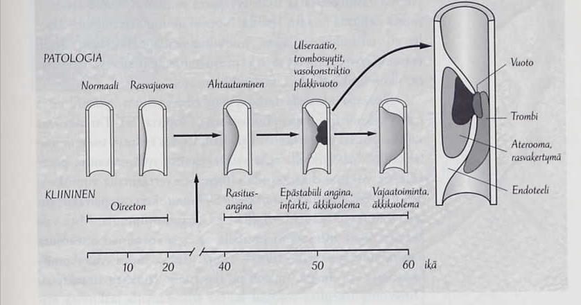 ASO-TAUTI ATHEROSCLEROSIS OBLITERANS ATEROSKLEROOSI