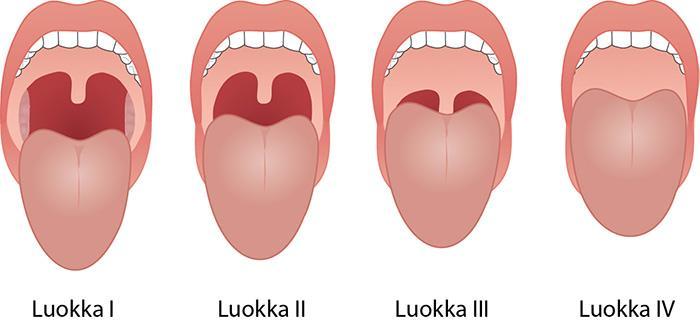 Käypä hoito -suositus 26 (42) 929 930 931 932 933 934 Kuvat [Kuva1]= Mallampati-luokitus Käypä hoito työryhmä Uniapnea (obstruktiivinen uniapnea aikuisilla) 28.2.2017 Mallampati-luokituksen avulla kliinisessä tutkimuksessa voidaan arvioida nielun ilmatilaa.