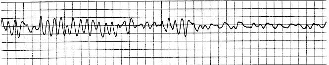 Defibrillaatio(t) + PPE Ei - iskettävä ASY / PEA Adrenaliini + PPE (+