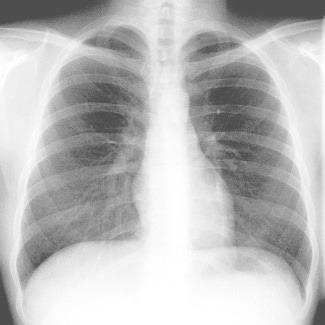 Luku 1 KEUHKOT JA RINTAKEHÄ Oheista röntgenkuvaa kannattaa tarkastella hartaasti. Kyseessä on yleisin röntgenkuva: thorax-rtg. Luut erottuvat vaaleina. Erotat helposti solisluut, sitten kylkiluut.