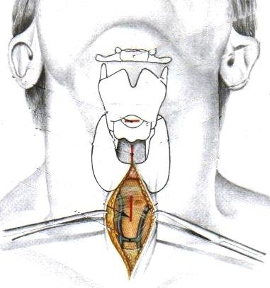 kuuluu myös iholihas, platysma.