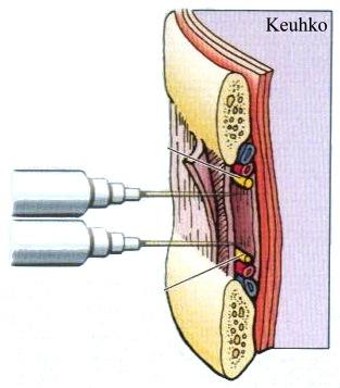 intercostalis posterior M. intercostalis intima Kylkivälisuonet ja hermot kulkevat kylkivälilihasten välissä Kylkiluu Kylkirusto intercostalis internan ja intiman väliin.