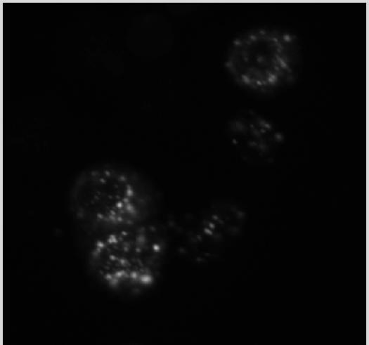 Laboratoriolöydökset (n=70, vv. 1997-99 Tays) kreatiniini > 100 µmol/l 79% proteinuria > 0.3 g/l 93% proteinuria > 3.