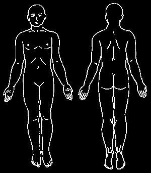 metsäkanalinnut) ja lintuhyttysten (Culex) välisessä endeemisessä kierrossa Tarttuu ihmiseen hyttysen puremasta yleisimmin loppukesällä Outbreak of 2002 Clinical observations SYMPTOM % Joint symptoms