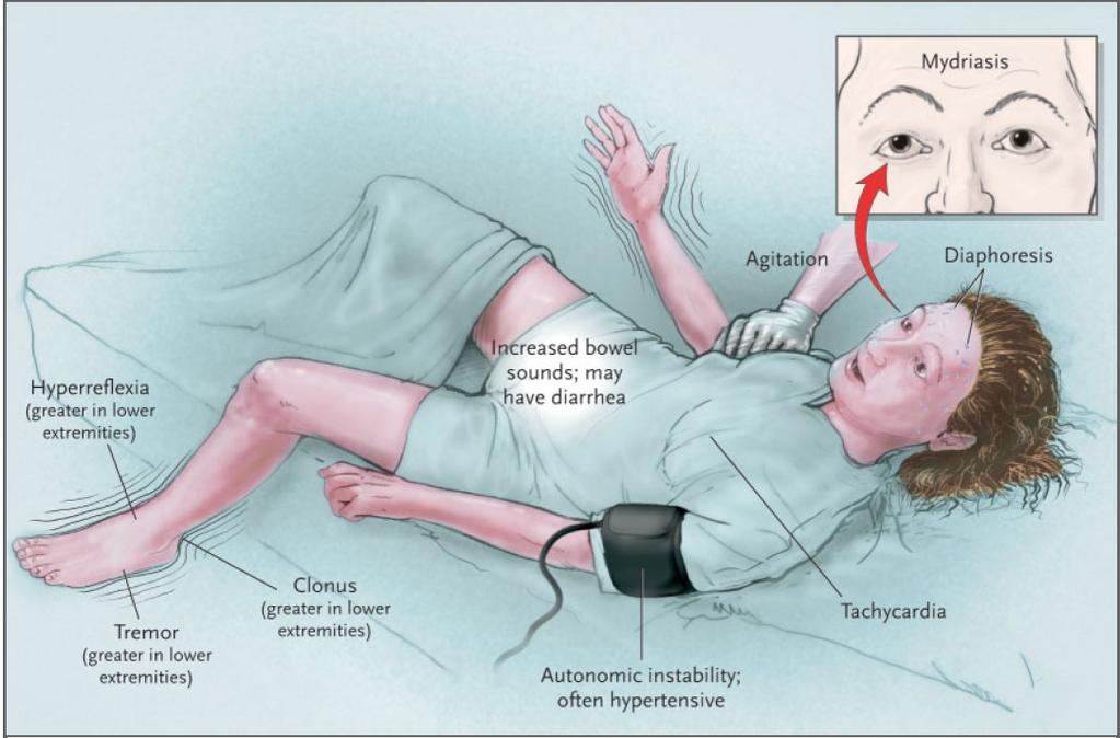 Serotoniinioireyhtymän oireet 7. Aiot vaihtaa depressiopotilaan nykyisen fluoksetiini (mm. Seromex, Fluoxetin) -lääkityksen amitriptyliiniin (Triptyl) tai moklobemidiin (mm. Aurorix, Moclobemid).