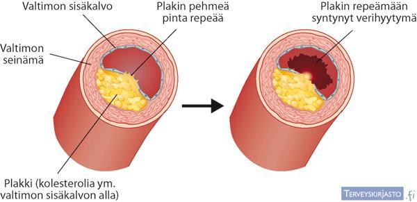 Valtimotauti voi yllättää äkillisesti Taudilla on myös äkillinen epävakaa muoto, jossa kovettumapesäkkeen eli plakin pinta rikkoutuu tai repeää.