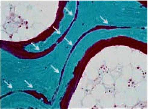 Osteoidin (varhaisluukudoksen) määrä ja jakautuminen epänormaalia, kun seerumin kalsidiolin pitoisuus on alle 75 nmol/l = epänormaali osteoidisaareke mineralisoitunut luu mineralisoitumaton osteoidi