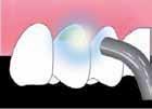 Annostelu Aplikointi, 10 s odotus 5 s kevyt puustaus 5 s voimakas puustaus 2Preparoidun hampaan suojaus