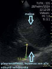 Kuva 2. Näkymä oikealta keskikainalolinjasta rintakehän alaosasta. Oikealla näkyy maksaa ja palleankaari, alhaalla pleuranestettä. Kuva 3. Verta sydänpussissa. Subksifoidaalinen näkymä.
