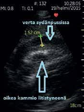 Näkymä oikealta keskikainalolinjasta rintakehän alaosasta. Nestettä oikean munuaisen ja maksan välissä ns. Morisonin tilassa.