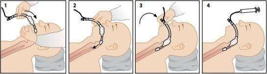 20 (67) asennossa 93 %:ssa tapauksista ja suojasi aspiraatiolta 100 %:ssa tutkituista elvytyksistä. Sairaanhoitajat kokivat larynx-tuubin asettamisen potilaalle helpoksi. (Kette ym. 2005, 21 25.