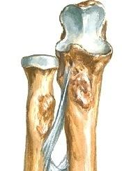 ligamentum coraco-acromiale. Bursat eli limapussit (slemsäck) ovat sidekudokseen muodostuneita ohutseinäisiä rakkulamaisia rakenteita, joiden sisällä on nivelnesteen kaltaista liukastus-nestettä.