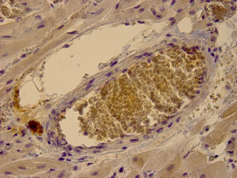 16. Niinimaki E, Muola P, Parkkila S, Kholovà I, Haapasalo H, Pastorekova S. Carbonic anhydrase IX deposits are associated with increased ascending aortic dilatation.