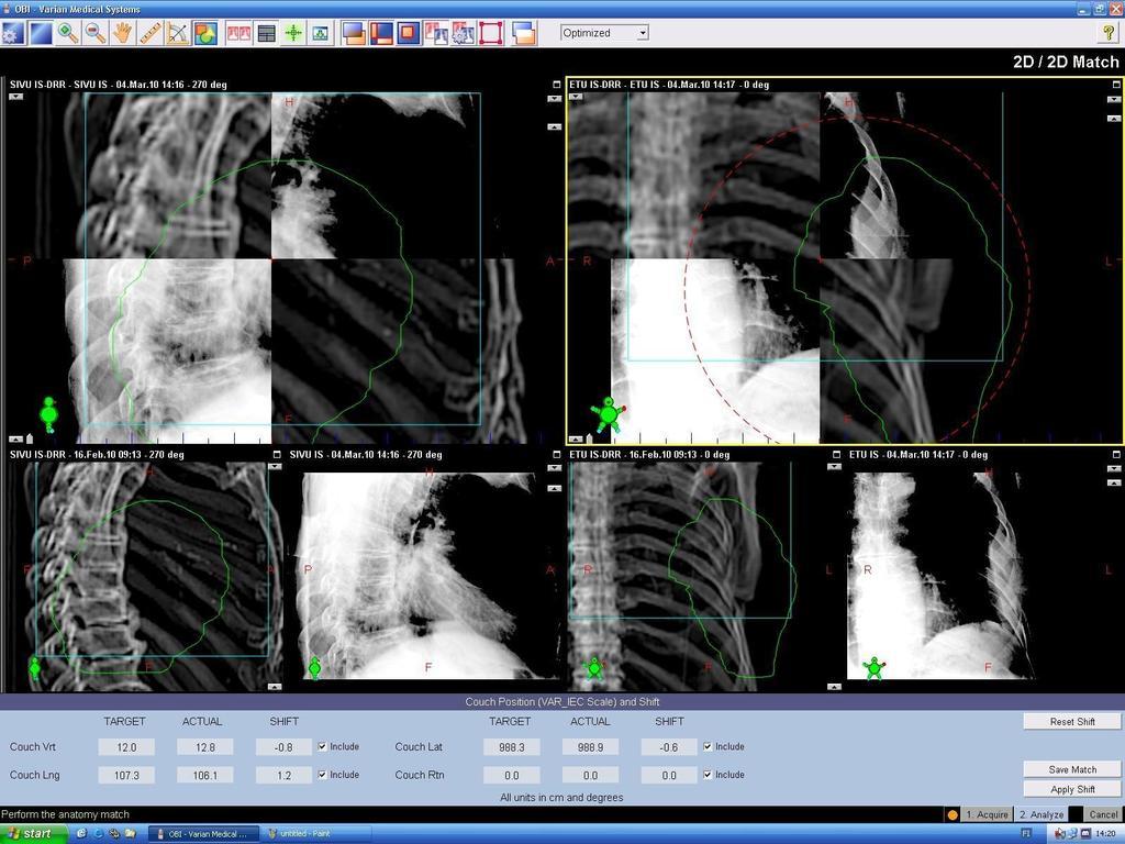 16 Asettelun jälkeen hoitokohde kuvataan sekä etu- että sivusuunnasta. Röntgenhoitaja, joka toimii koneenkäyttäjänä, fuusioi (Kuva 3) otetut kuvat vastaaviin DRR-kuviin luisten rakenteiden mukaan.