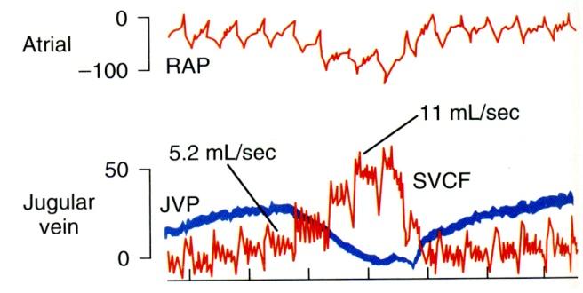 Hengityspumppu Sekä rintakehän sisäinen paine, oikean eteisen paine (RAP) että kaulalaskimon paine (JVP) laskevat normaalin