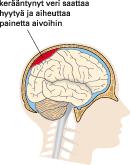 14. Diabetes 7. Tapaturman aiheuttama aivoverenvuoto Verensokerin epätasapaino voi aiheuttaa tajunnan häiriöitä. Hypoglykemiassa verensokeri laskee liian alas, alle 4 mmol/l.